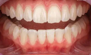 Depois - Apinhamento